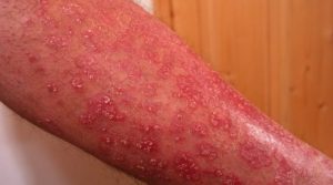 Aké kožné choroby môžu byť symptómom niečoho vážnejšieho?
